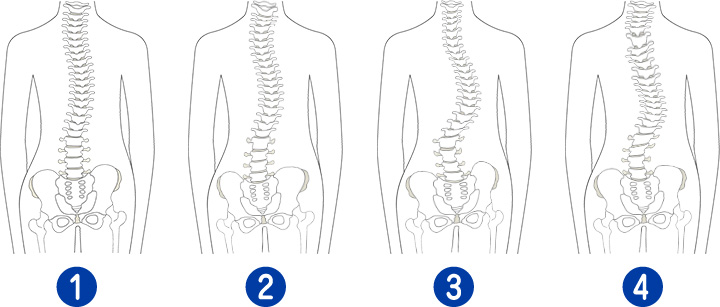 背骨の曲がりは大きく4パターンです。
