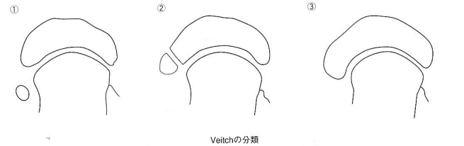 有痛性外脛骨について