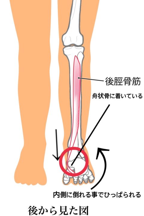 有痛性外脛骨について