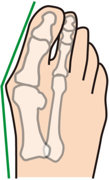 外反母趾について