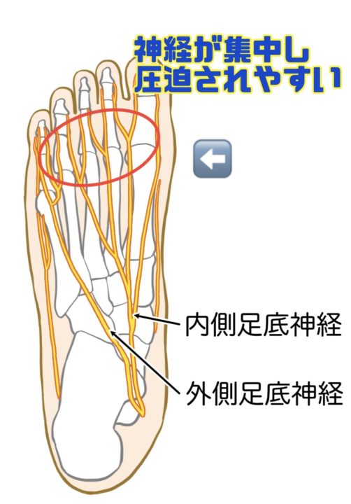 モートン病について